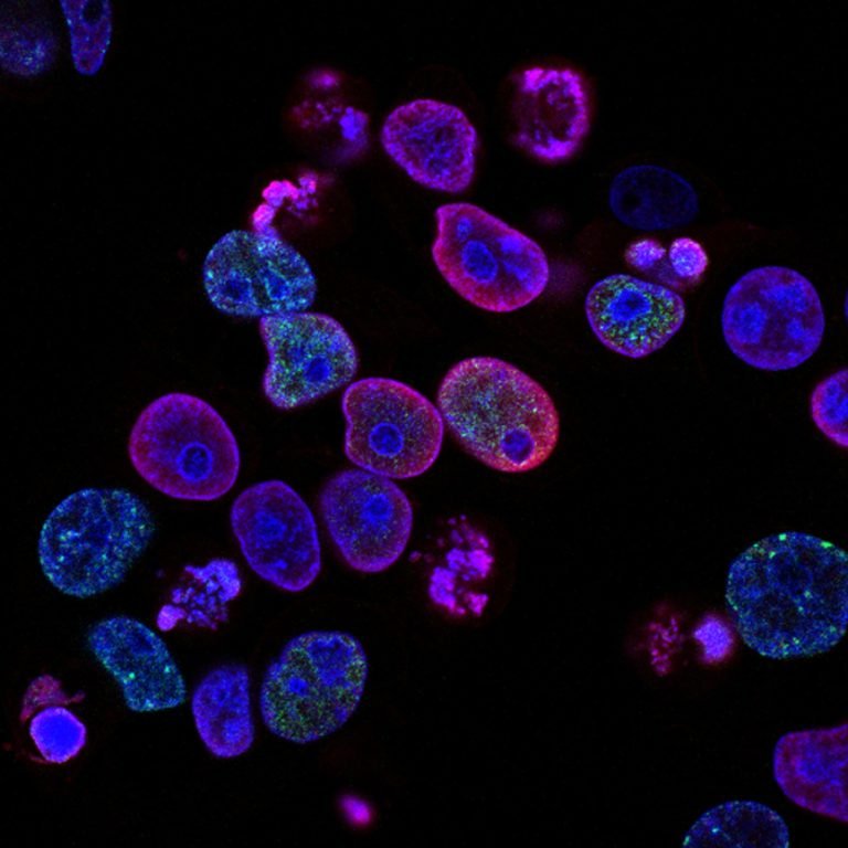 Fluorescence microscopy image of cancer cells, nuclei glowing blue against a dark field